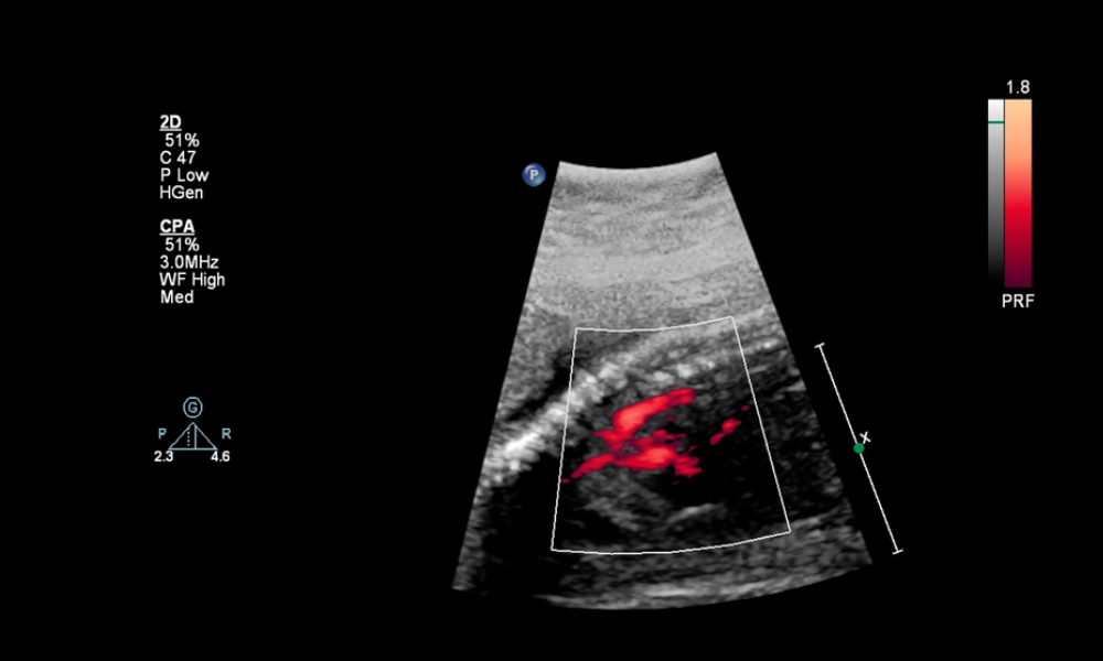 تصویر اکوکاردیوگرافی قلب